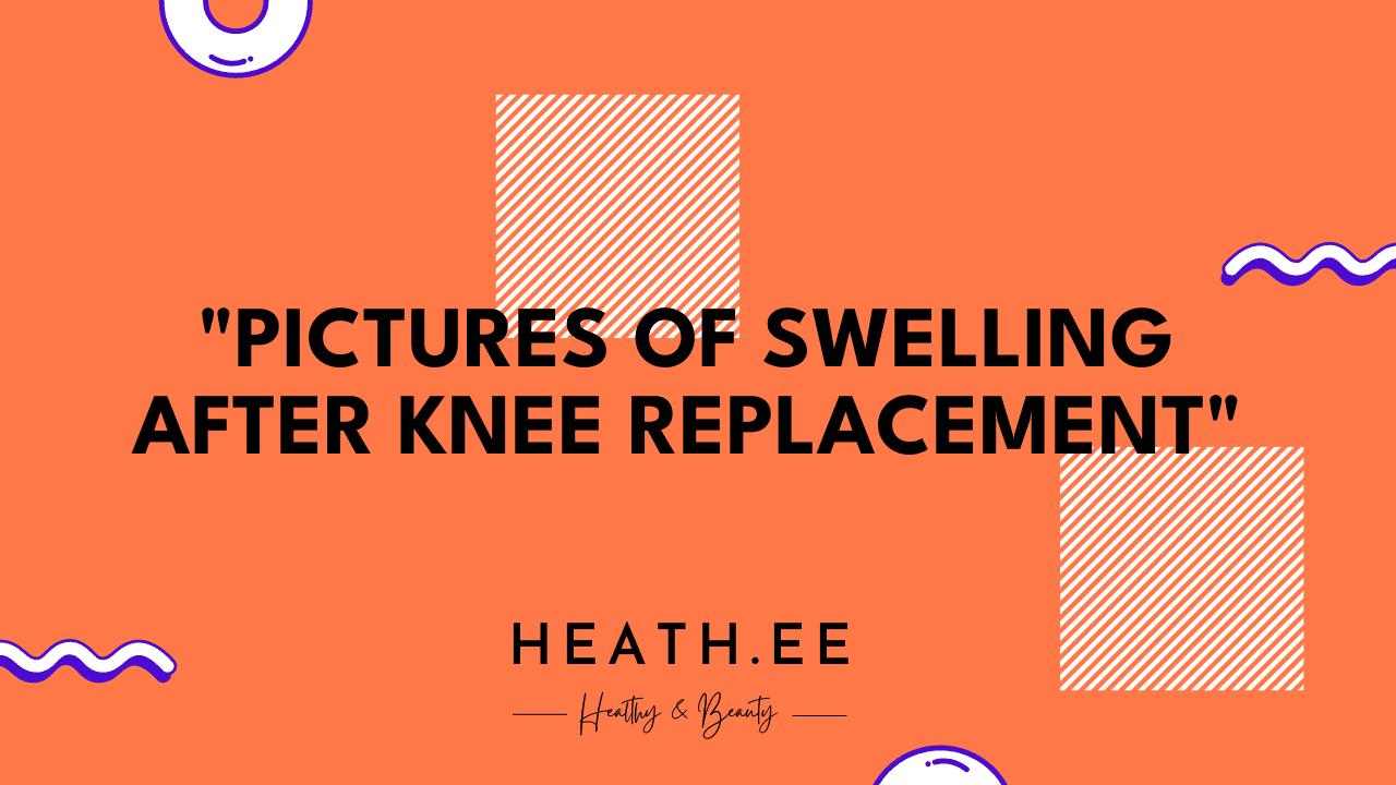 Pictures of Swelling After Knee Replacement: What You Need to Know - Heathe