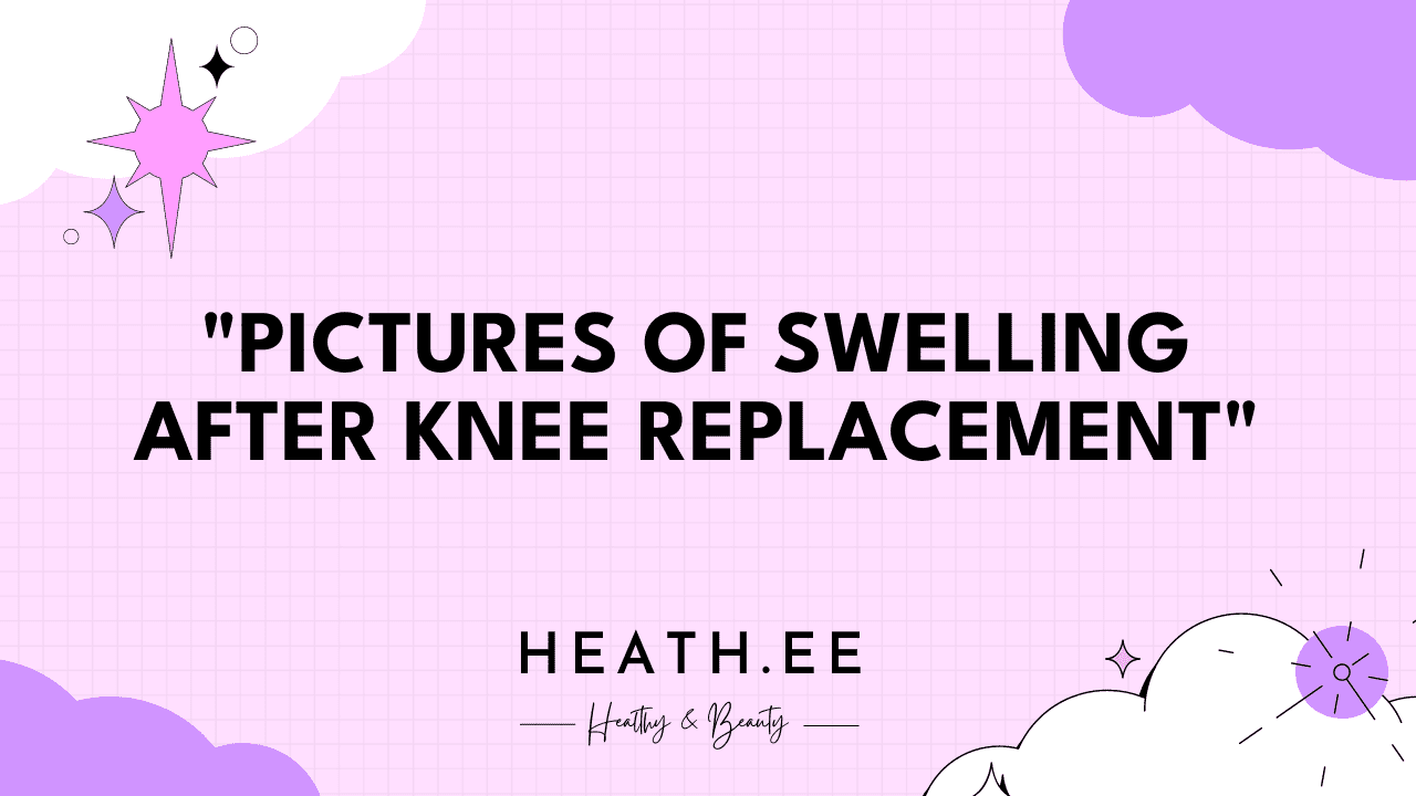 Pictures of Swelling After Knee Replacement: What You Need to Know - Heathe